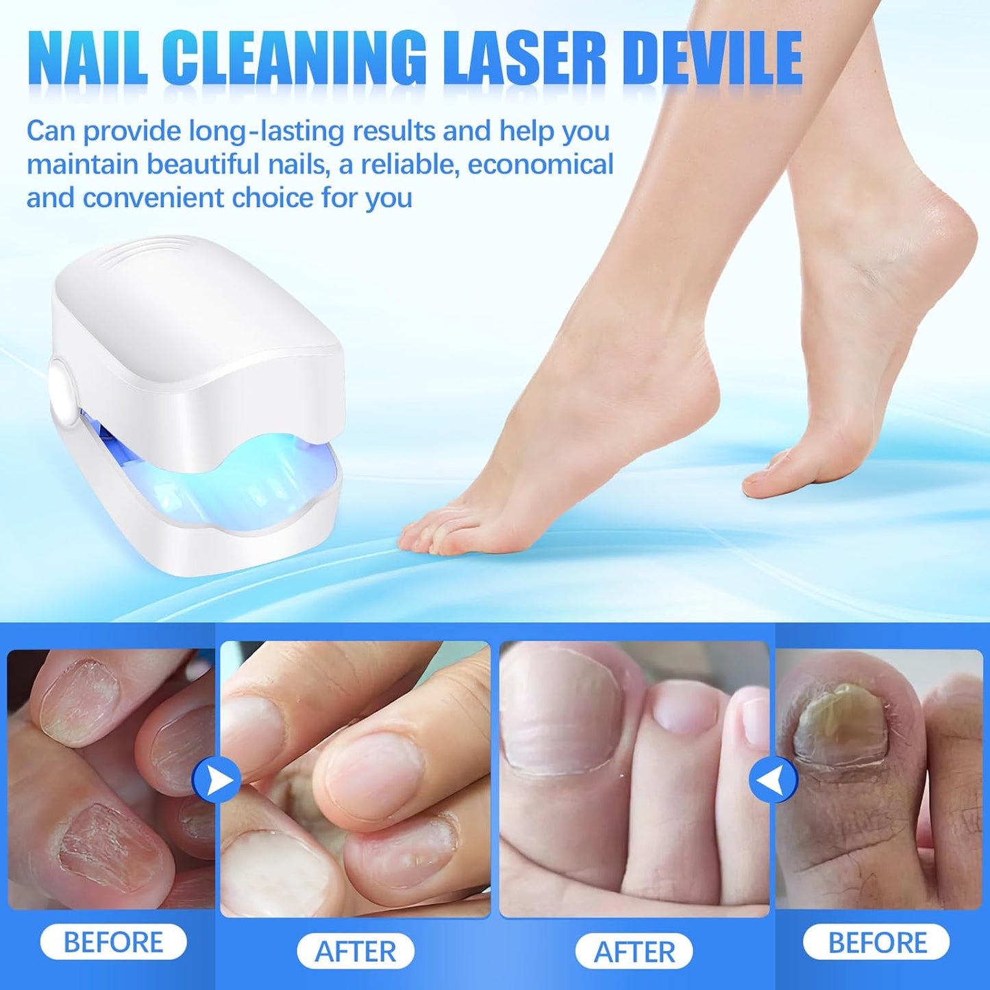 12915 Rechargeable Nail Fungus Treatment For Toenail Toe Nail Fungal Treatment Nail Fungus Laser Device Anti-fungal Nail Treatment For Hand Feet Infections Remover For Home Use