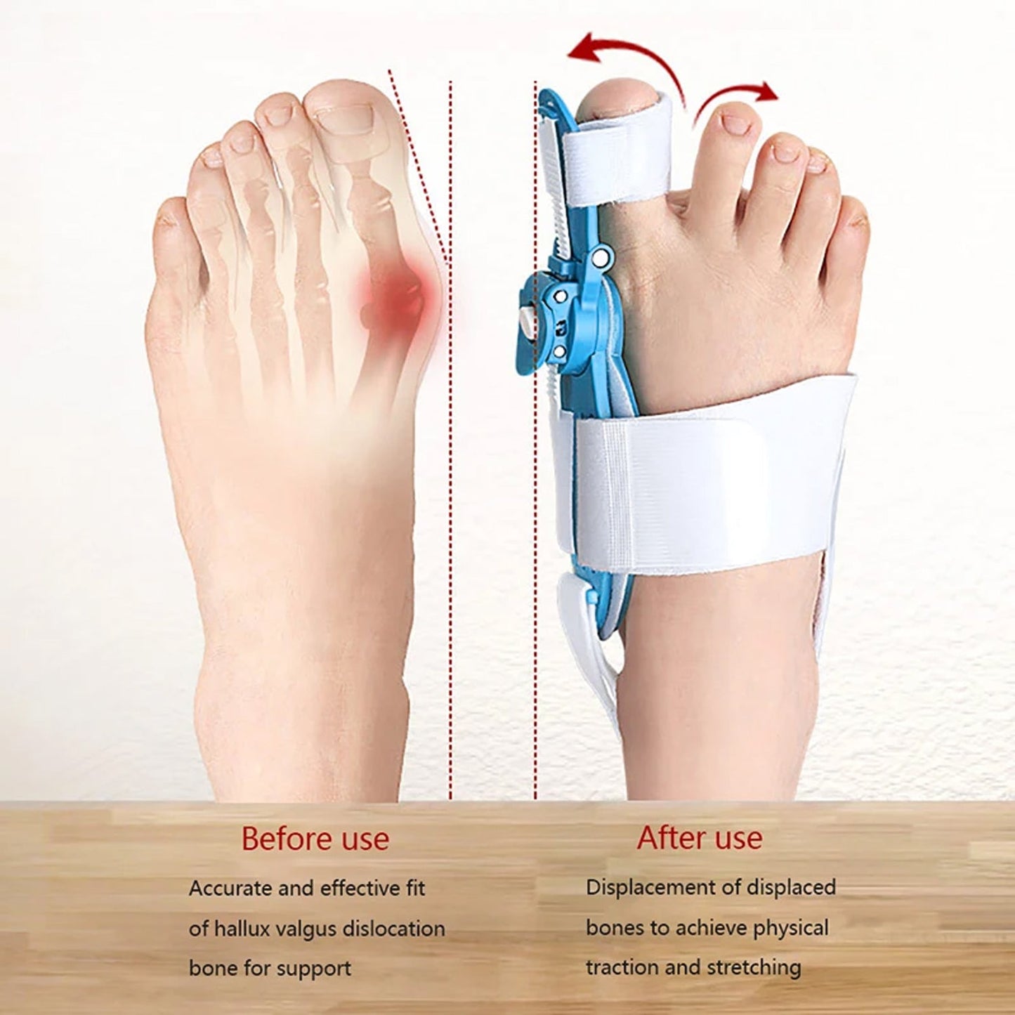 Adjustable Bunion Support Splint Ã¢â‚¬â€œ Hallux Valgus Corrector for Men & Women