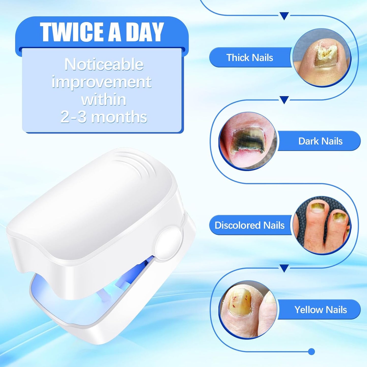Rechargeable Nail Fungus Laser Ã¢â‚¬â€œ Anti-Fungal Device for Toenails, Hands & Feet (Home Use)